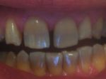 Tetraciklinski zubi i dijasteme  pre